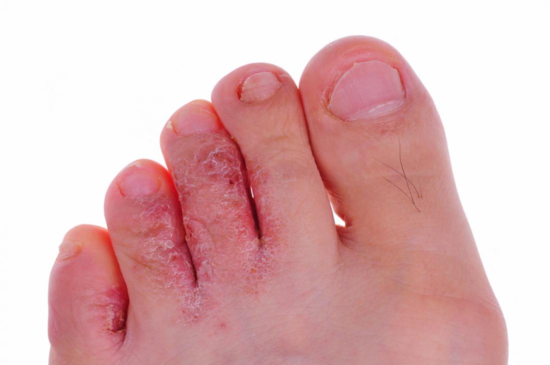 Infection fongique