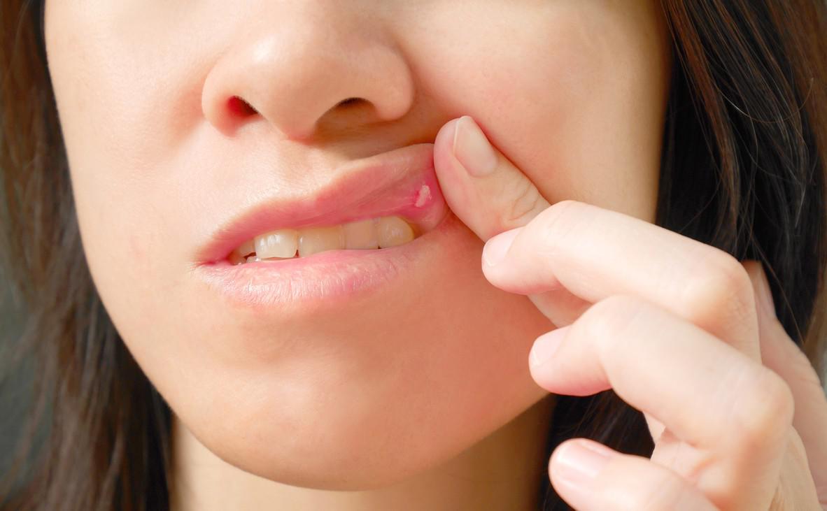 Boutons de fièvre et aphtes