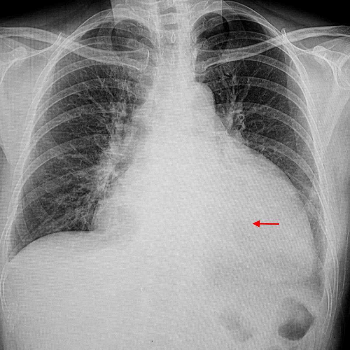 Cardiomyopathie (dilatée) congestive