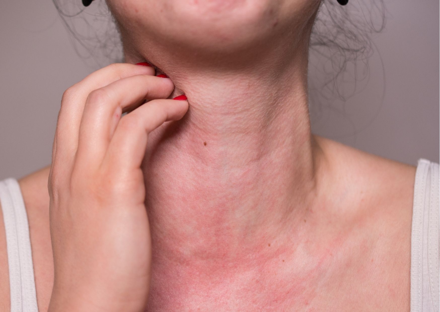 allergies