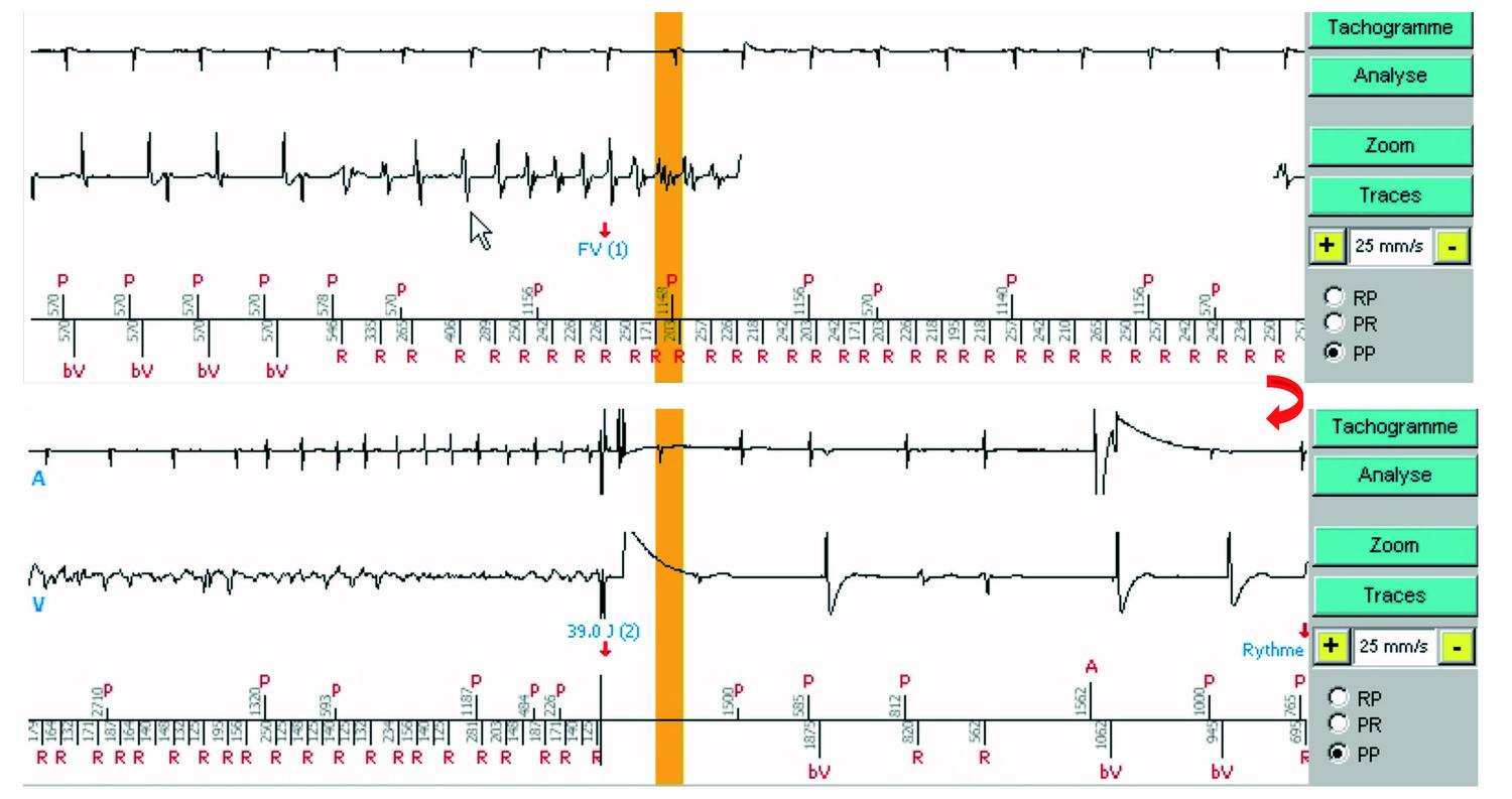 Fibrillation-ventriculaire