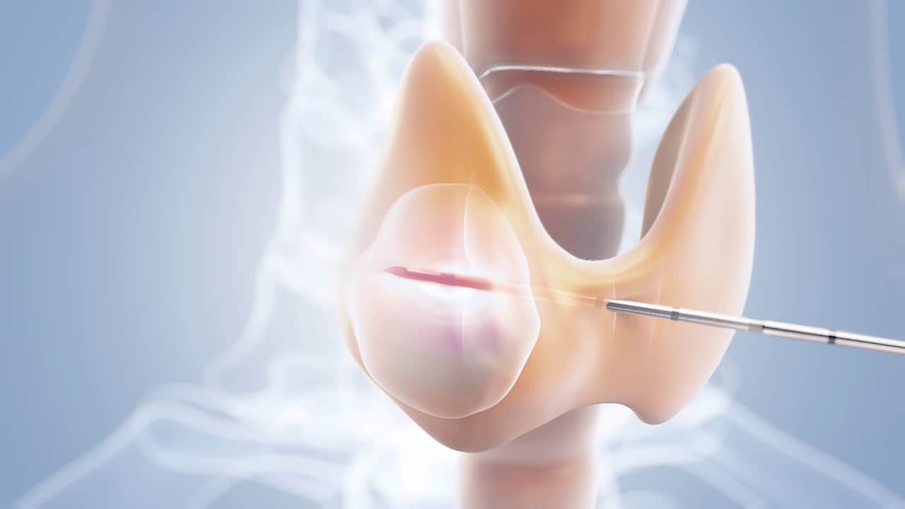 Ablation chirurgicale de la glande parathyroïde