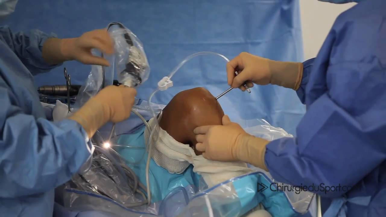 Reconstruction du ligament croisé antérieur du genou