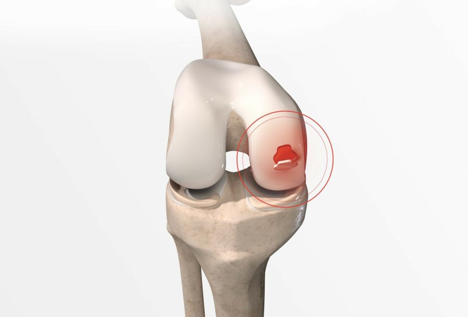 Remplacement de l'articulation du genou